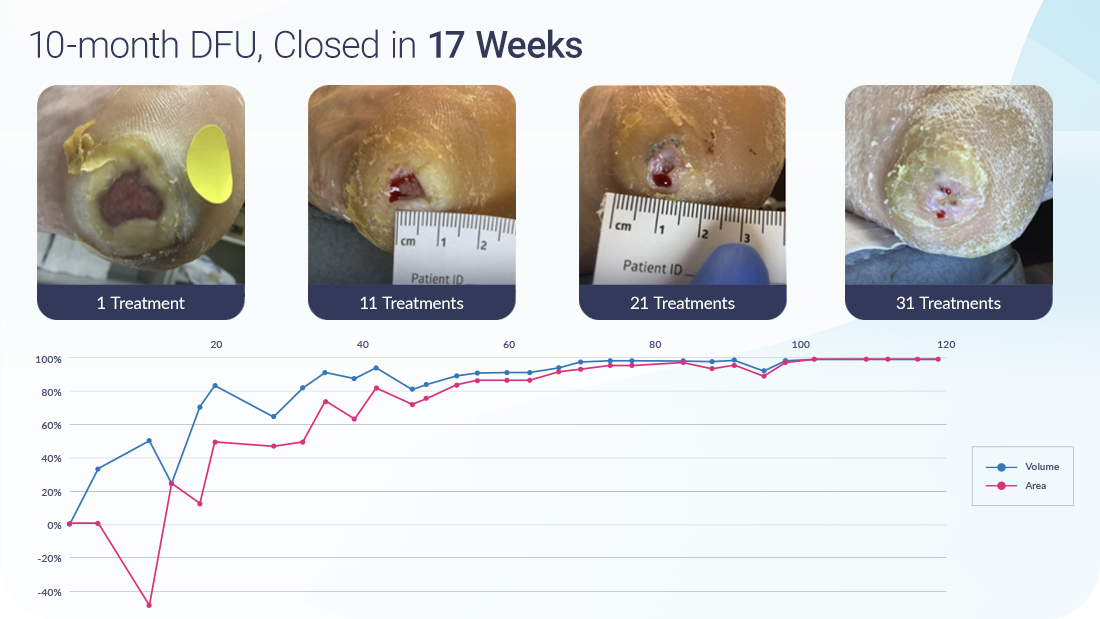 Vaporox-Case-Study-DFU-10-months-17-weeks