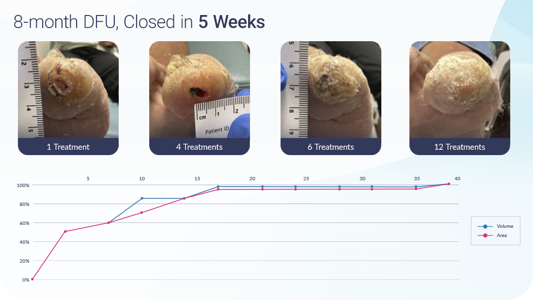 Vaporox-Case-Study-DFU-8-months-5-weeks